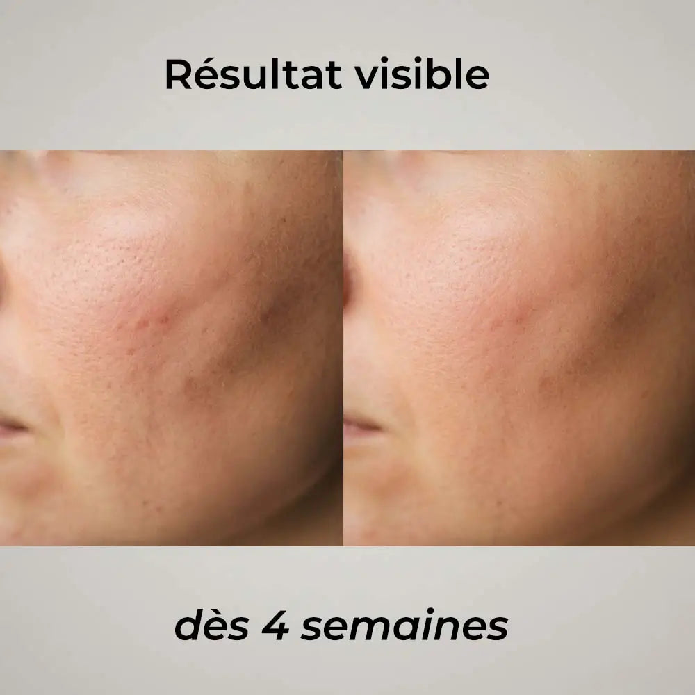 Dermaroller Visage – Micro-Aiguilles &amp; Absorption des Soins